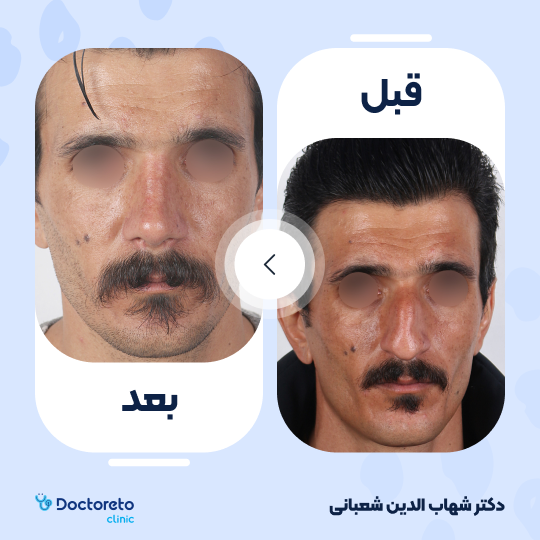 عمل جراحی مجدد زیبایی بینی (رینوپلاستی) دکتر شهاب الدین شعبانی در مشهد 40