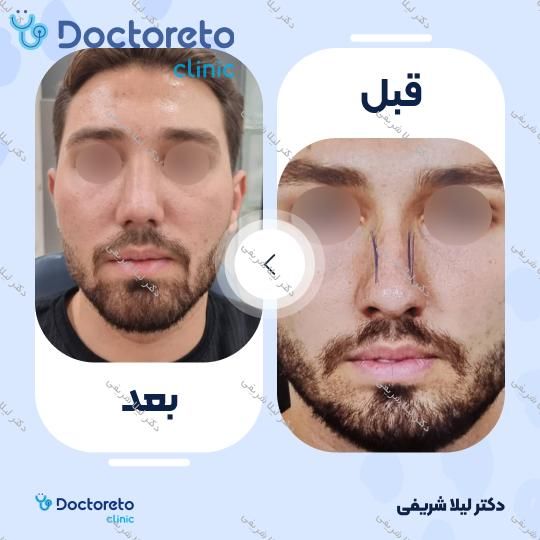 عمل زیبایی بینی (رینوپلاستی)