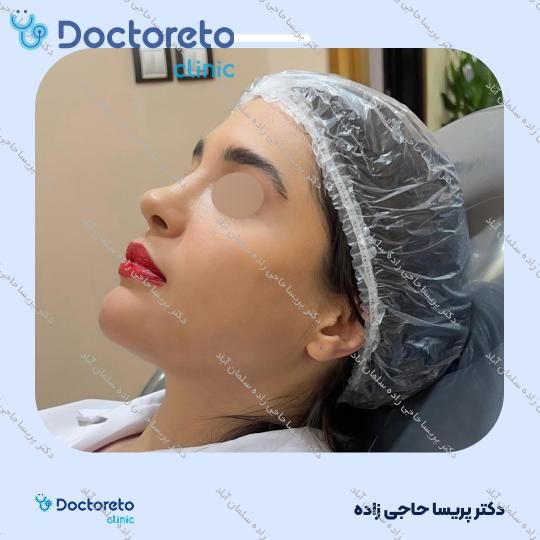 تزریق ژل چانه با برند زیشل (1CC)