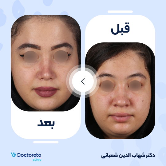 عمل جراحی مجدد زیبایی بینی (رینوپلاستی) دکتر شهاب الدین شعبانی در مشهد 22