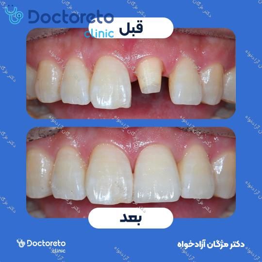 روکش دندان زیرکونیا (هر واحد)