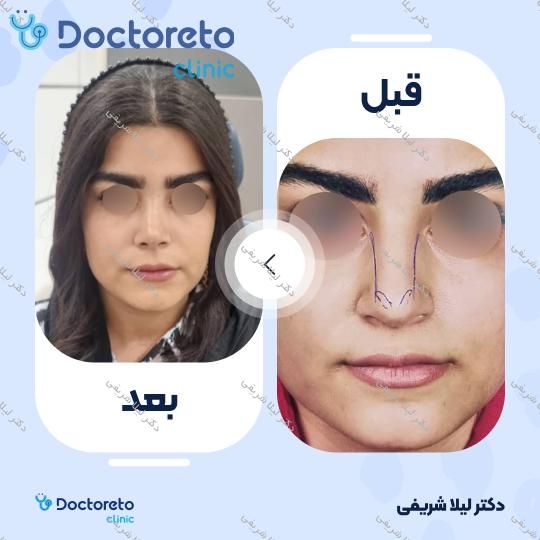 عمل زیبایی بینی (رینوپلاستی)