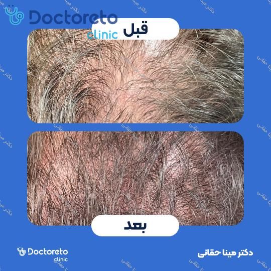 مزوتراپی موی سر با برند فیوژن (1cc) دکتر مینا حقانی در اصفهان 7