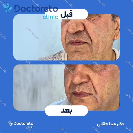 جوانسازی، آبرسانی و کلاژن سازی صورت با مزوژل جالپرو HMW صورتی (هر جلسه) دکتر مینا حقانی در اصفهان 1