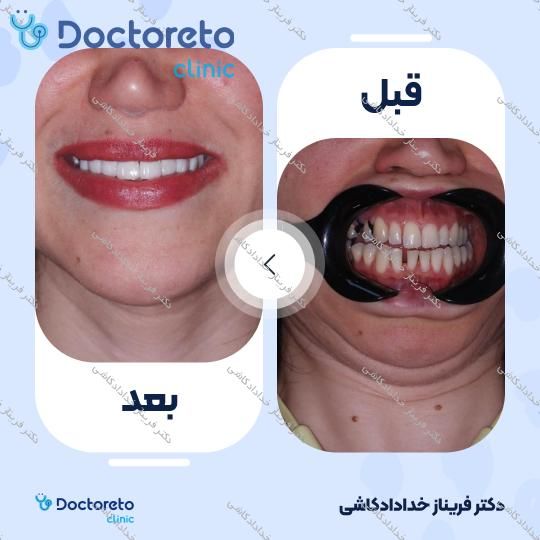ونیر کامپوزیت ips لیرینگ (هر واحد) دکتر فریناز خدادادکاشی در تهران 3