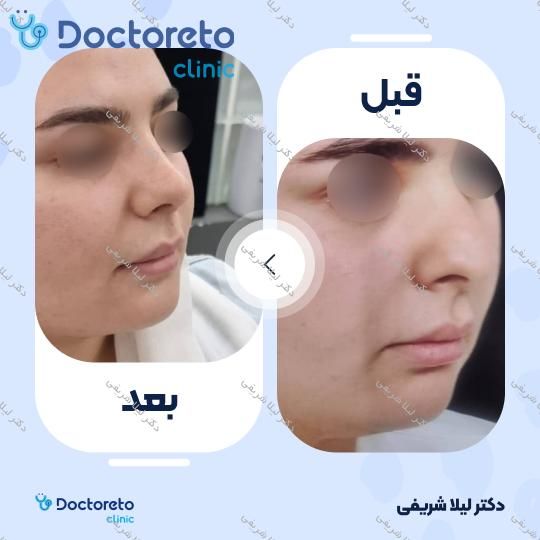 عمل زیبایی بینی (رینوپلاستی)