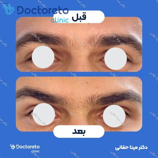 تزریق بوتاکس صورت (پیشانی، خط اخم، پنجه کلاغی) با برند مصپورت دکتر مینا حقانی در اصفهان 7