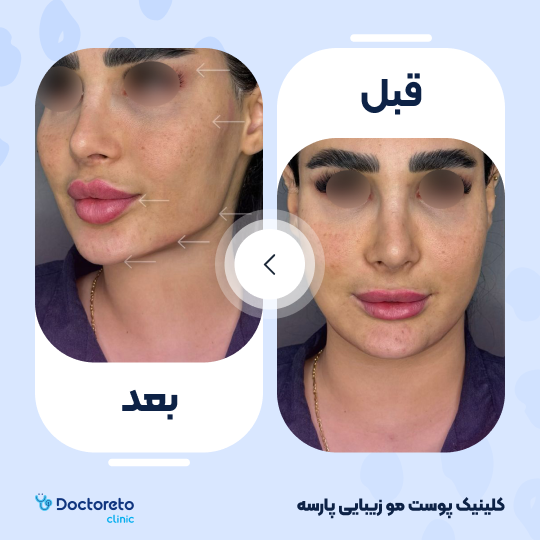 تزریق ژل گونه با برند نورامیس (1cc)
