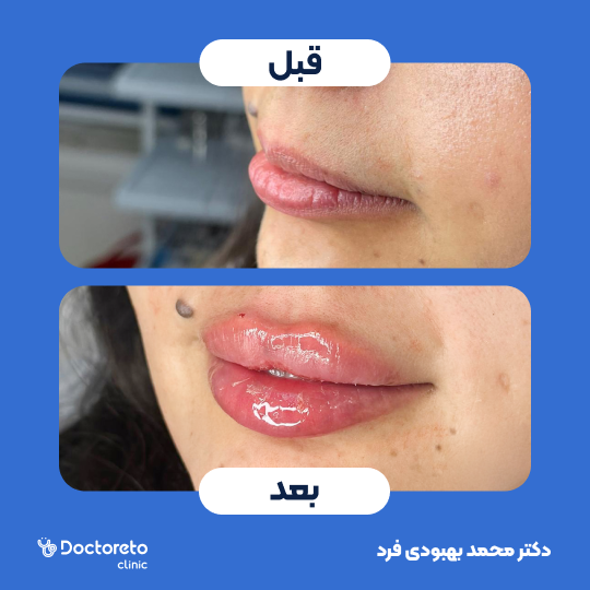 تزریق ژل لب با برند رووفیل پلاس (1cc) دکتر محمد بهبودی فرد در مشهد 5