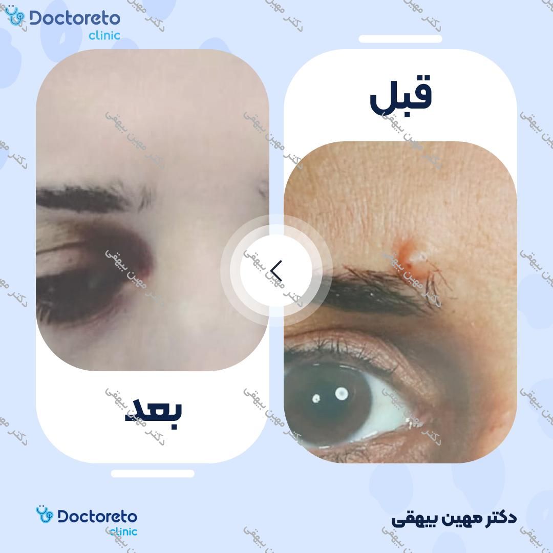 برداشتن خال بزرگ با دستگاه Vulkan (Licht) (هر عدد) دکتر مهین بیهقی در بابل 2