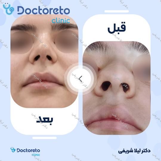 عمل زیبایی بینی (رینوپلاستی)