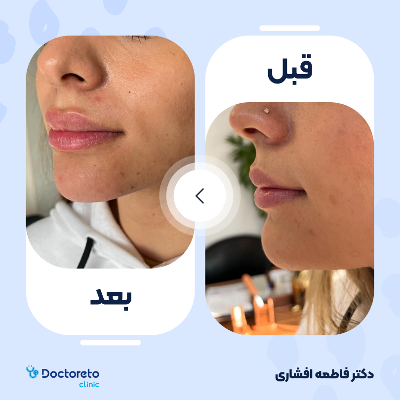 تزریق ژل لب با برند نورامیس (1cc) دکتر فاطمه افشاری در کرج 2