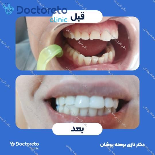 ونیر کامپوزیت توکویاما ژاپن (هر واحد) دکتر نازی برهنه پوشان در تهران 19