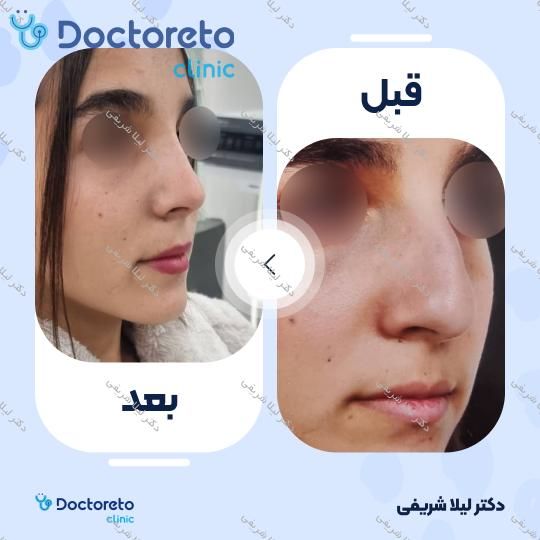 عمل زیبایی بینی (رینوپلاستی)