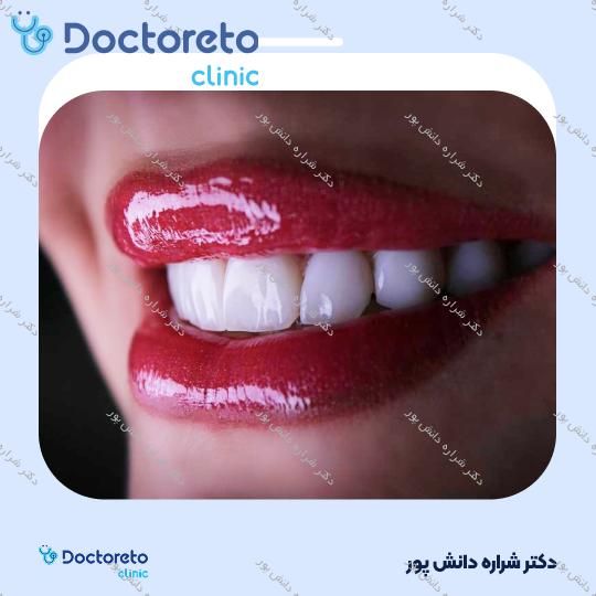ونیر کامپوزیت سارمکو سوئیس (هر واحد) دکتر شراره دانش پور در تهران 6