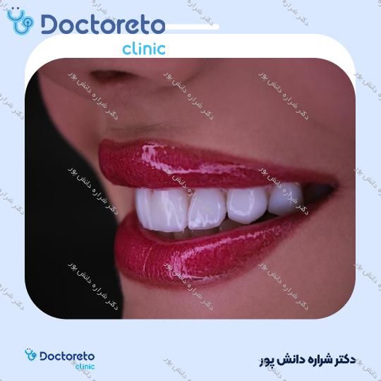 ونیر کامپوزیت سارمکو سوئیس (هر واحد) دکتر شراره دانش پور در تهران 8