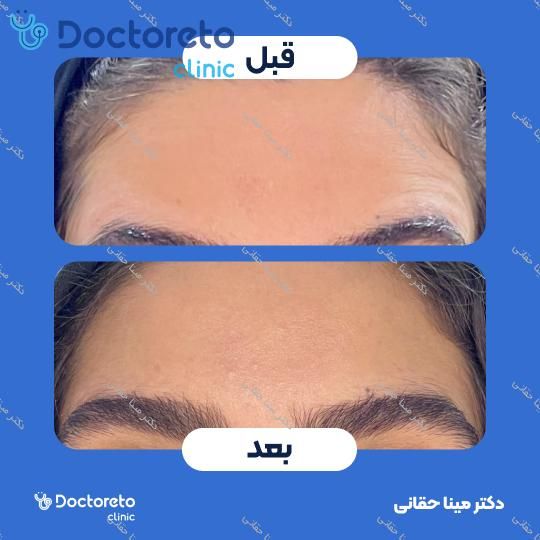 تزریق بوتاکس صورت (پیشانی، خط اخم، پنجه کلاغی) با برند مصپورت دکتر مینا حقانی در اصفهان 4