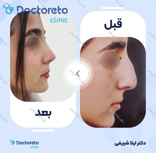 عمل زیبایی بینی (رینوپلاستی)
