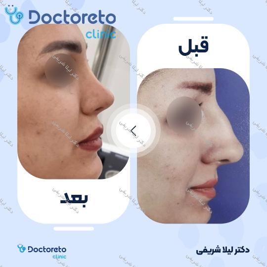 عمل زیبایی بینی (رینوپلاستی)