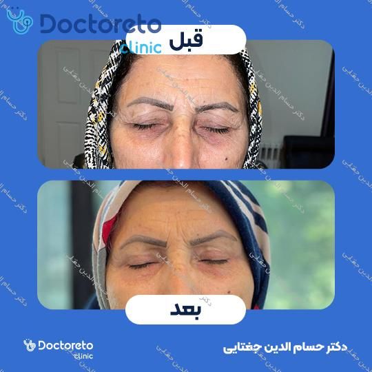 بلفاروپلاستی پلک بالا به روش جراحی دکتر حسام الدین جغتایی در ساری 15