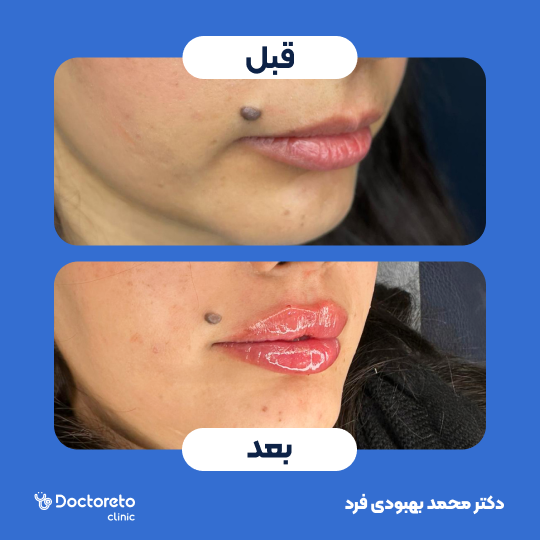 تزریق ژل لب با برند رووفیل پلاس (1cc) دکتر محمد بهبودی فرد در مشهد 4