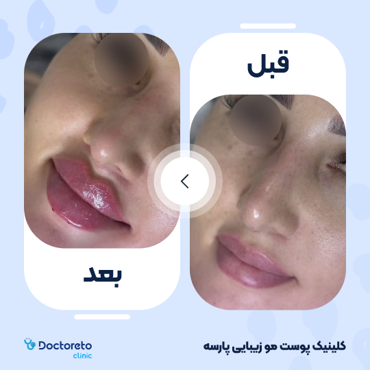 تزریق ژل لب با برند رووفیل (1cc)