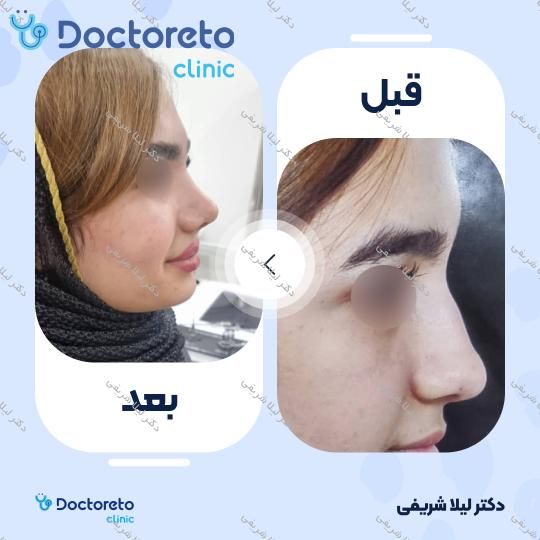 مشاوره جراحی انحراف بینی (سپتوپلاستی)