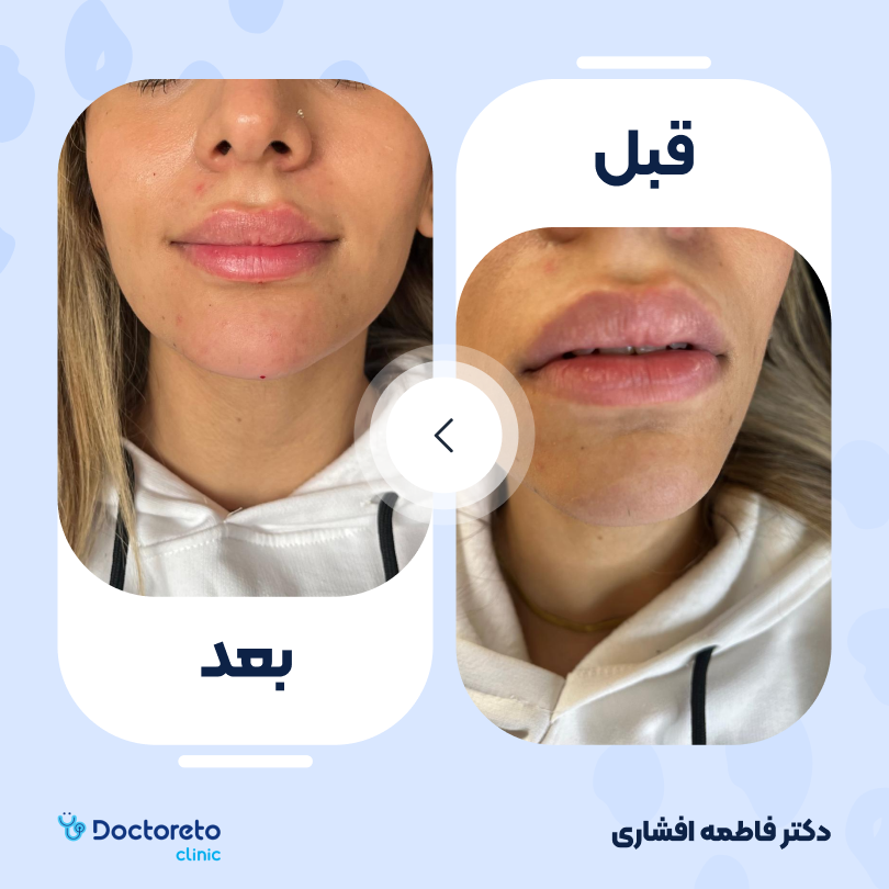 تزریق ژل لب با برند درموفیل (1cc) دکتر فاطمه افشاری در کرج 2