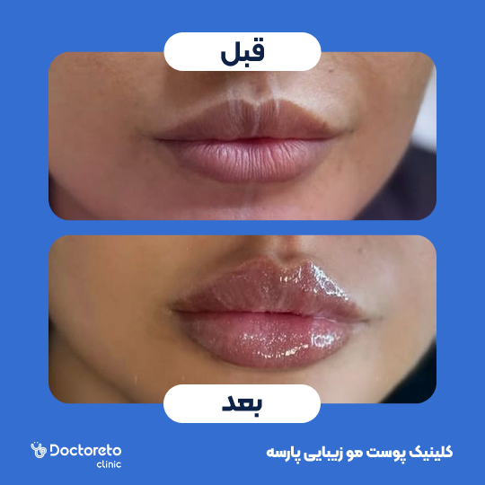 تزریق ژل لب با برند درمال استایل ( 1cc)
