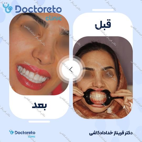 لمینت سرامیکی ایمکس vip (هر واحد)