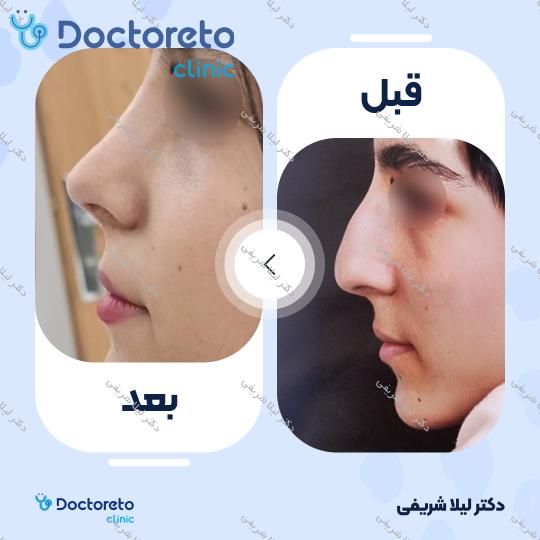مشاوره جراحی انحراف بینی (سپتوپلاستی)