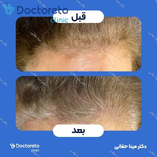 مزوتراپی موی سر با برند ام سی سی ام (1cc) دکتر مینا حقانی در اصفهان 6