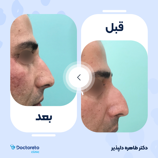 تزریق ژل بینی با برند نورامیس (1cc) دکتر طاهره دلپذیر در شیراز 8