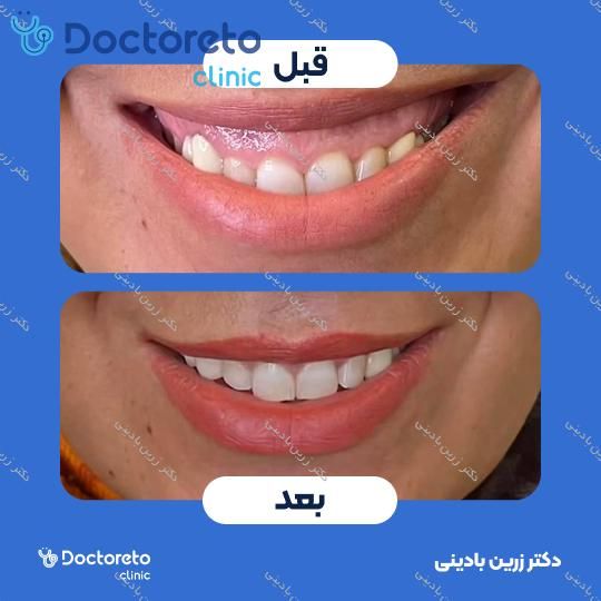 تزریق بوتاکس لبخند لثه ای با برند مصپورت