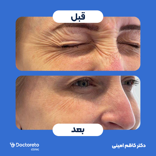 تزریق بوتاکس صورت ( خطوط پنجه کلاغی) با برند مصپورت