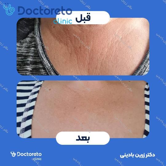 جوانسازی گردن و دکلته با مزوژل جالپرو سوپر هایدرو (هر جلسه)