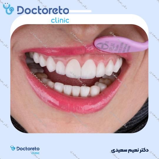 لمینت آی پی اس ایمکس (هر واحد)