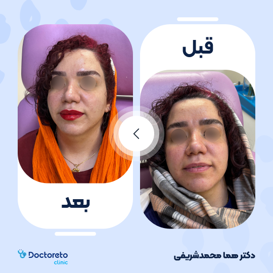 تزریق ژل لب با برند اینووسنس (1cc)
