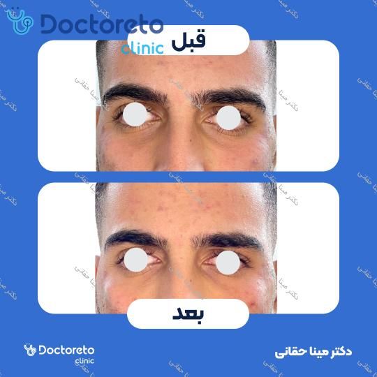تزریق ژل زیر چشم با برند بلوترو (1CC)
