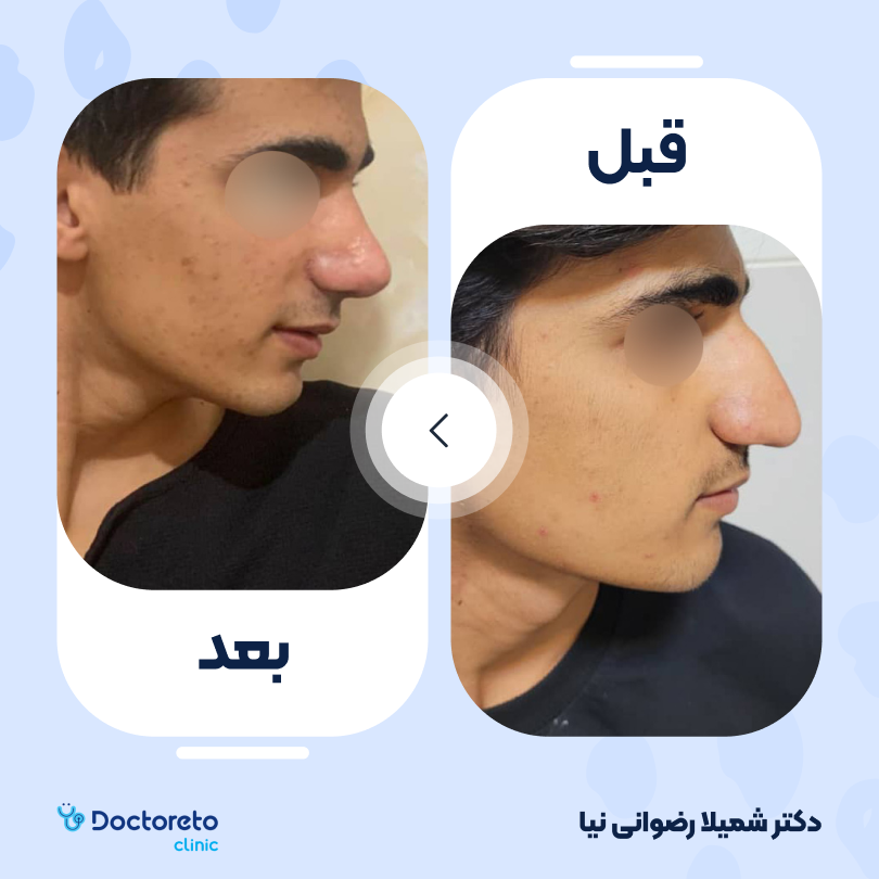 عمل زیبایی بینی گوشتی (رینوپلاستی) دکتر شمیلا رضوانی نیا در شیراز 9