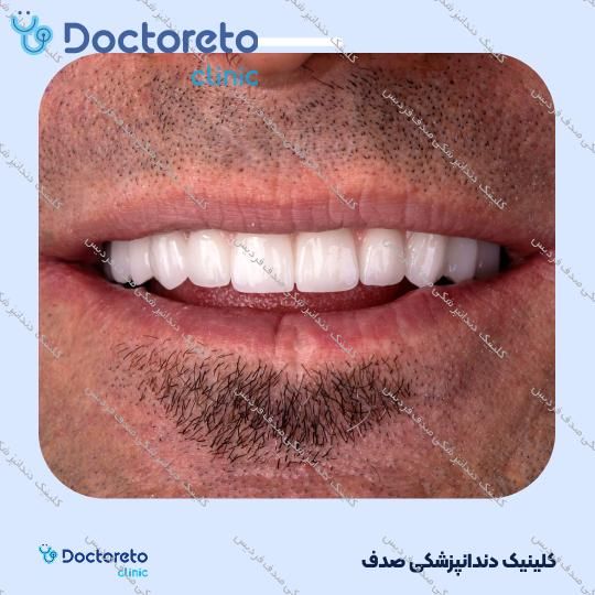 ایمپلنت core1 کره ای با روکش (هر واحد)