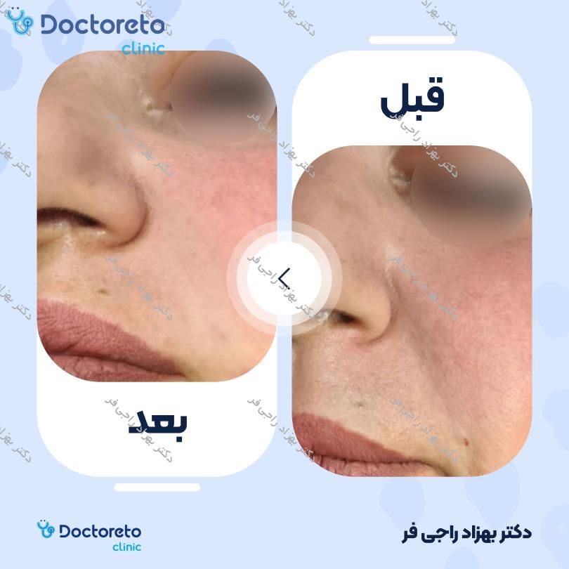 تزریق ژل گونه با برند رووفیل (1cc)