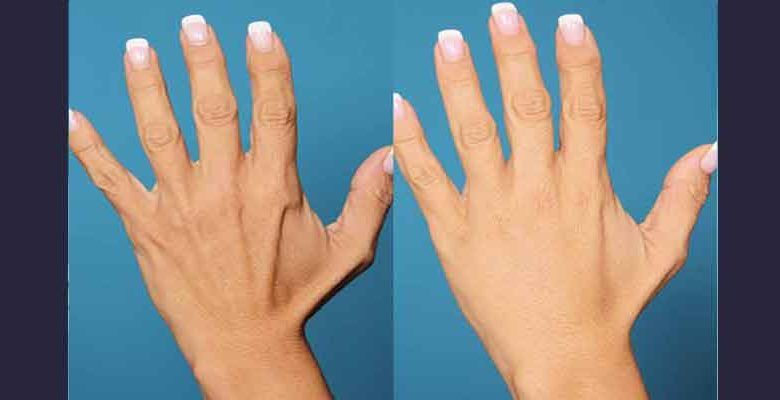 تزریق چربی به ناحیه صورت