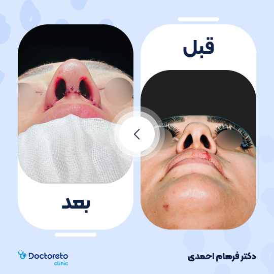 عمل جراحی مجدد زیبایی بینی (رینوپلاستی)