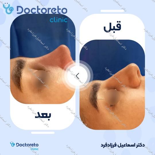 عمل زیبایی بینی (رینوپلاستی)