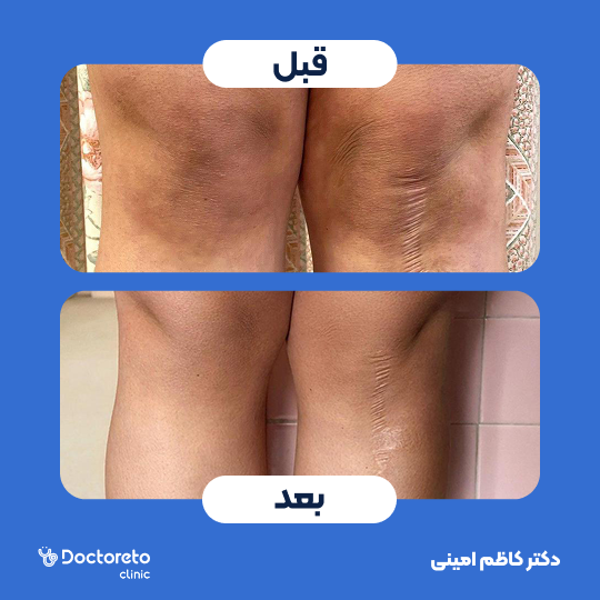 جوانسازی و رفع تیرگی پوست با کربوکسی تراپی (هر جلسه)