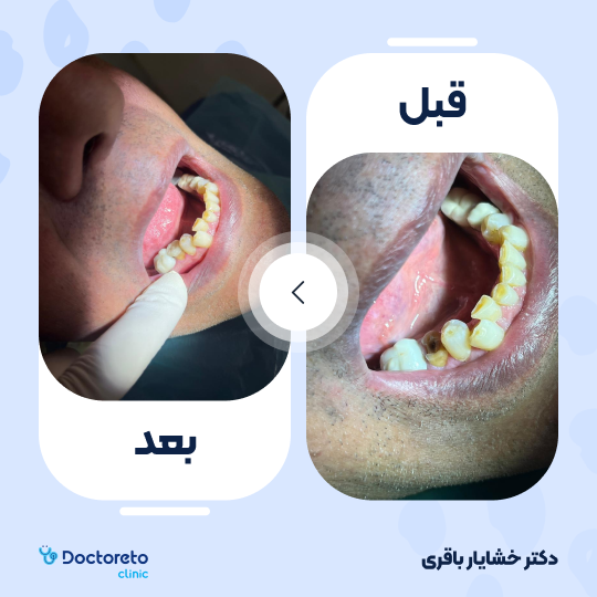 روکش تمام سرامیک زیرکونیا (هر واحد)