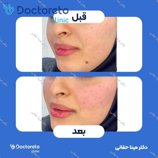 تزریق ژل گونه با برند استایلیج (1CC)