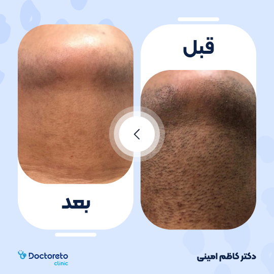 لیزر موهای زائد آقایان (زیر گردن) با دستگاه جونولوکس کره ای