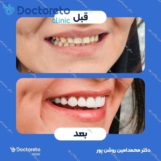 لمینت سرامیکی ایمکس (هر واحد)